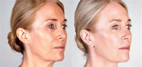 Skin Tightening Procedures For Face