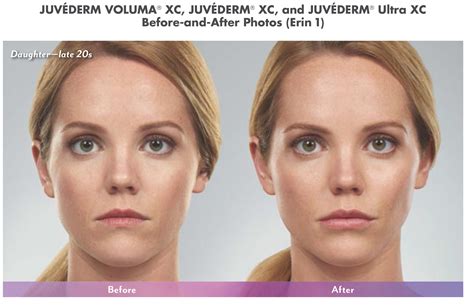 Juvederm Cheek Fillers Before And After - All You Need Infos