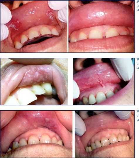 Figure 1 from Oral lichenoid lesions of the upper lip. | Semantic Scholar