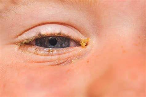 Pink Eye In Babies: Signs, Causes And Treatment