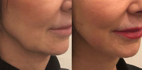 Kybella for Jowls: a game changer | U Med Spa, Plano TX