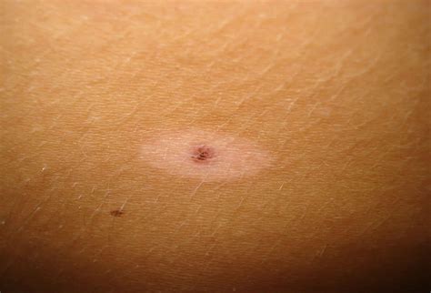 Halo nevus causes, symptoms, diagnosis & halo nevus treatment