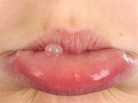 Mucocele (speekselklier cyste) op de lip (patientenfolder)