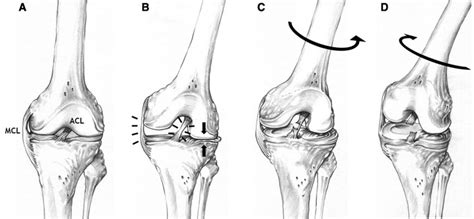 ACL Injury Prevention: Injury Mechanisms | Power Athlete