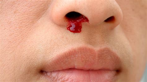 Home Remedies: 4 steps to stop a nosebleed - Mayo Clinic News Network