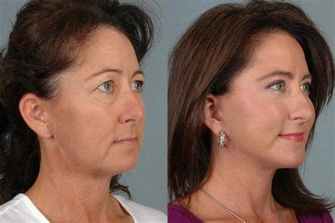 B-Spoke Clinic: Difference Between Facelift, Mid-Facelift, And Mini ...