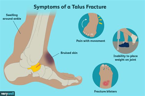 Talus Contusion