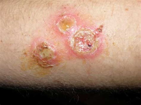 Staph Infection - Causes, Symptoms, Prevention, Treatment, Contagious ...