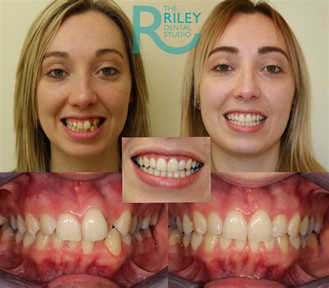 Invisalign Before And After Crowding