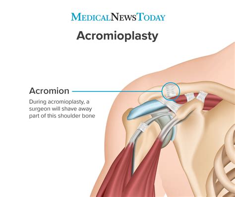 Pin on bones + orthopedics