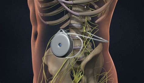 Understanding the Procedure of Intrathecal Drug Pump Implant - Charlton ...