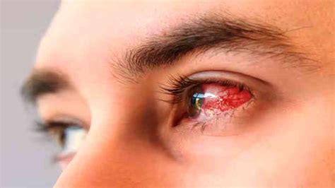 Conjunctivitis:Eye Flu Symptoms, Effective Treatment at Home