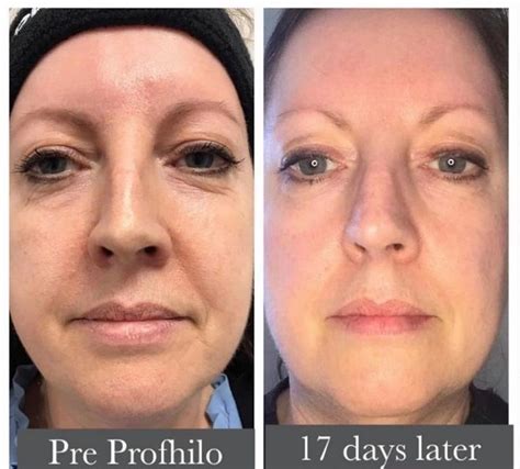 Profhilo is the new injectable moisturiser | Skin aesthetics, Acne ...