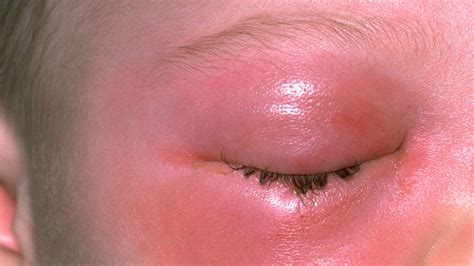 Eye Orbital Cellulitis