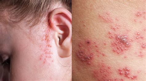 Different Types Of Skin Rashes | Images and Photos finder