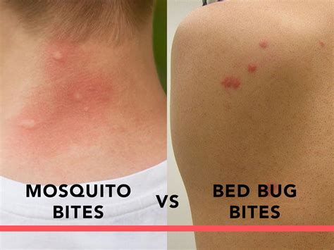 Mosquito Bites Vs Bed Bug Bites