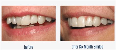 Clear Bracket Braces Before And After Transparent PNG - 1650x715 - Free ...