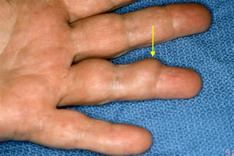 GIANT CELL TUMOR OF TENDON SHEATH (XANTHOMA) | Hand Surgery Resource