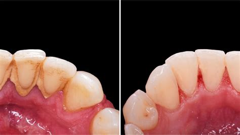 Deep Teeth Cleaning: Before and After - Dental Health Society