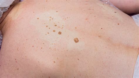 Can Age Spots Be Raised? Exploring The Truth Behind Skin Bumps