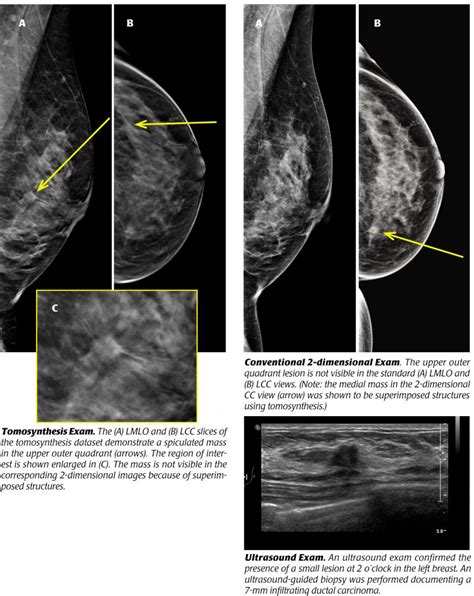 Tomosynthesis, revolutionary screening for breast cancer