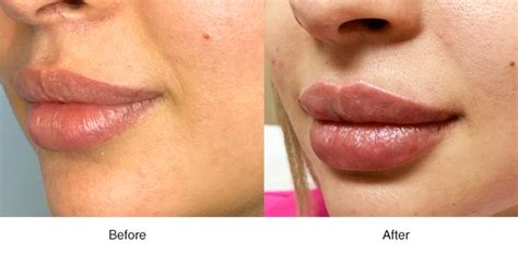 Lip Augmentation – Boss MD Plastic Surgery – Bergen County, NJ