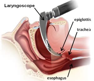 ADVANCE ORAL ENDOTRACHEAL INTUBATION