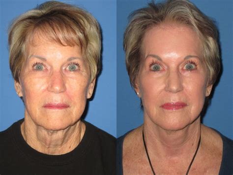 Facelift Before And After Photos | Elite Facial Plastic Surgery