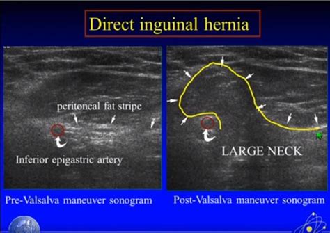 Ultrasound Imaging of Hernia Parts 1 + 2 of 4 – A YouTube Video | Tom ...