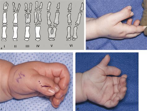 36 Polydactyly | Plastic Surgery Key