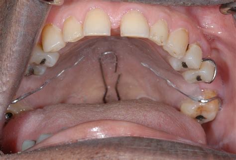 Palatal Lift Prosthesis | Aragon Prosthodontics