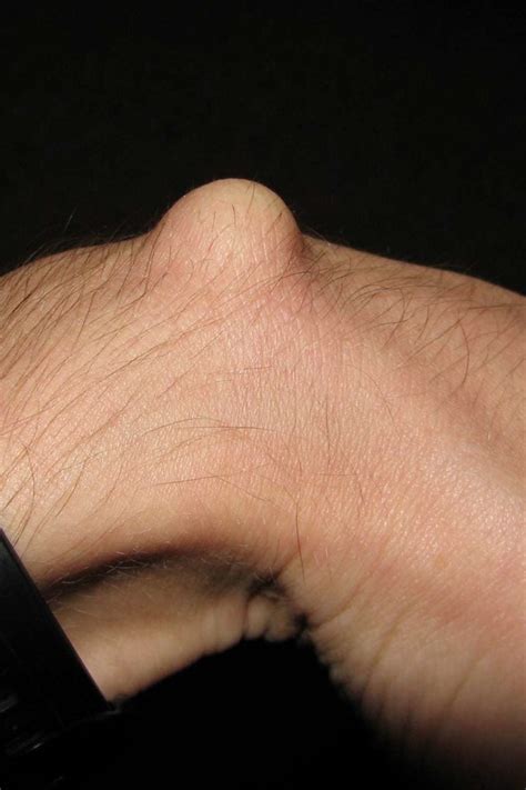 Ganglion cyst: Symptoms, causes, and treatment