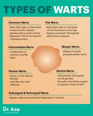 How to Get Rid of Warts Naturally + Wart Symptoms, Causes - Dr. Axe