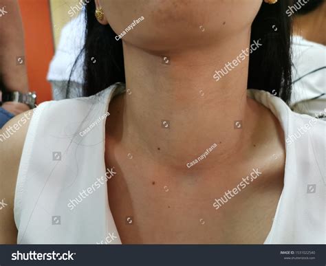 Diffuse Thyroid Swelling Goitre Cause Hypothyroidism Stock Photo ...