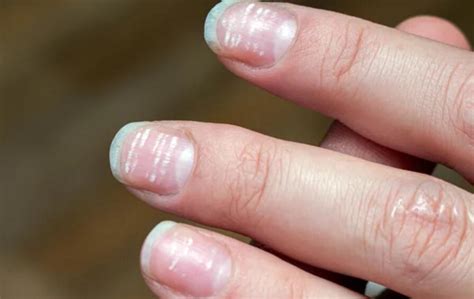 White Fingernails and Liver Disease: Common Causes