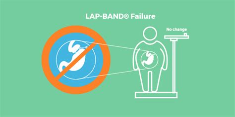 LAP-BAND® Problems and Complications - Complete List - Bariatric ...