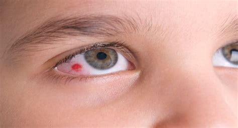 Viral infection of the eyes - symptoms and prevention | TheHealthSite.com