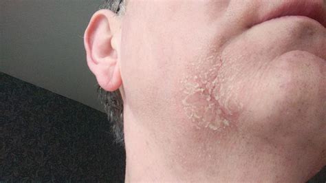 Skin rash on face | Diabetes Forum • The Global Diabetes Community