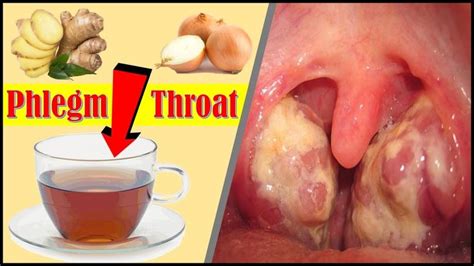 How to get rid of phlegm stuck in throat fast | Home remedy to clear m ...