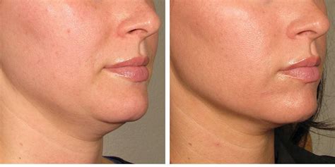 How Laser Skin Tightening Works - Radiofrequency Skin Treatment Details