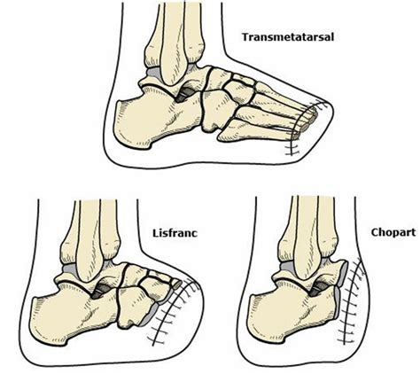 Amputation causes, types of amputation and amputation complications