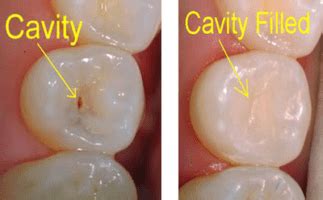 Filling-Cavity - All Smiles Dent Spa