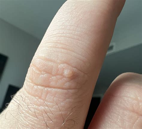 is this a wart on my knuckle? what is it? : r/DermatologyQuestions