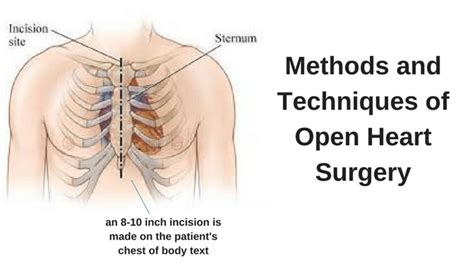 Open Heart Surgery: Complications and FAQs.