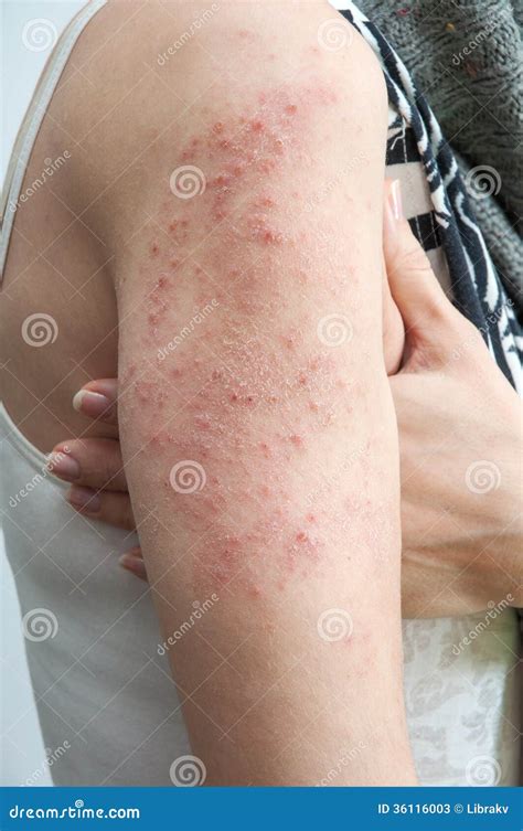 Allergic Rash Dermatitis Eczema Skin Stock Photo | CartoonDealer.com ...