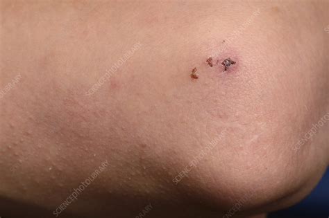 Taser injury - Stock Image - C029/6053 - Science Photo Library