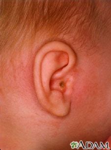 Ruptured eardrum | UF Health, University of Florida Health