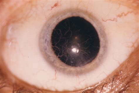 Anterior Corneal Dystrophy