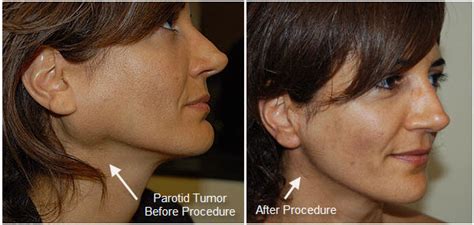 removal-parotid-tumor - Parotid Tumor Surgery | Salivary Gland Surgery ...