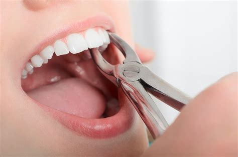 When is a Tooth Extraction Necessary as an Adult?